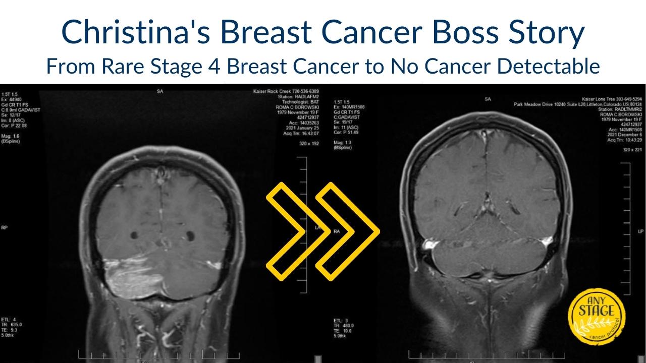 stage 4 invasive carcinoma breast cancer